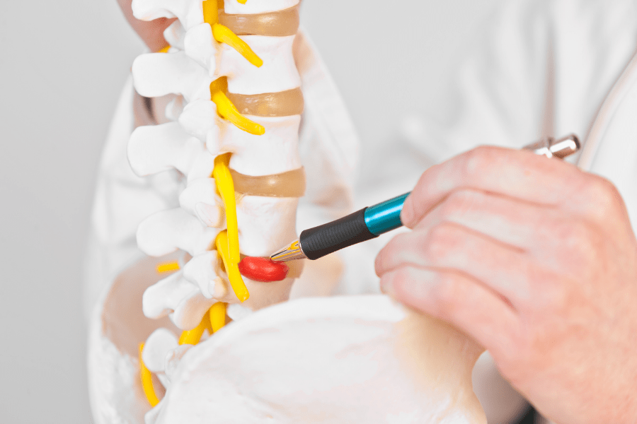 A doctor is pointing to a herniated disc on a medical model of the spine